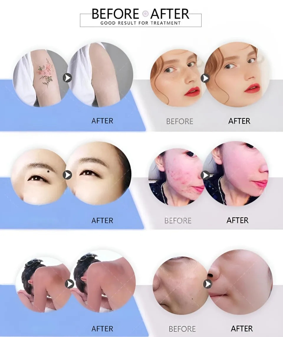 All-in-OneBeauty Device for Permanent Hair Removal & Pigment Treatment - ElectronAge