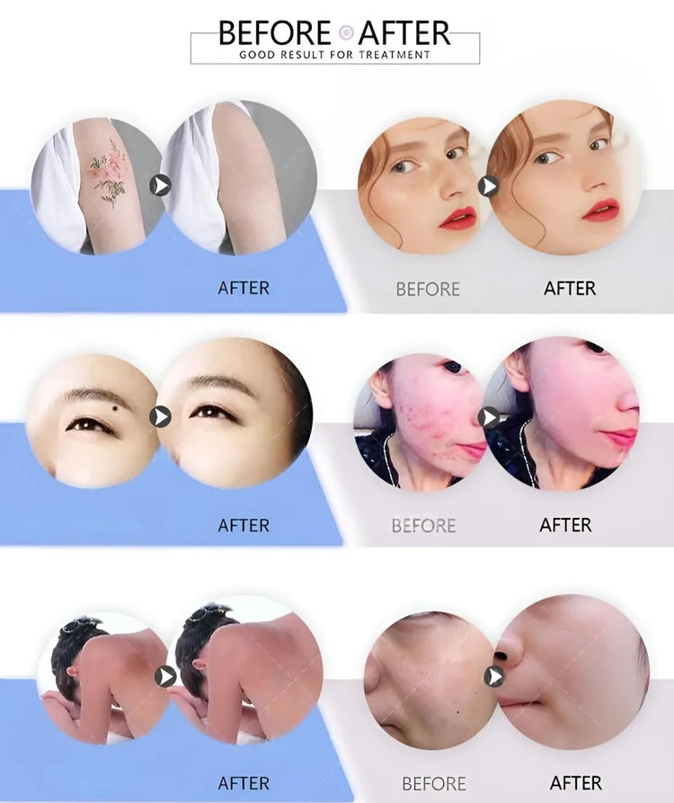 All-in-OneBeauty Device for Permanent Hair Removal & Pigment Treatment - ElectronAge